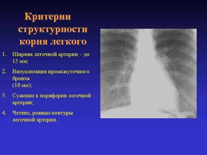 Критерии структурности корня легкого 1. Ширина легочной артерии – до 15 мм; 2. Визуализация