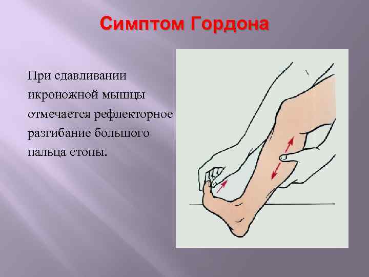 Симптом Гордона При сдавливании икроножной мышцы отмечается рефлекторное разгибание большого пальца стопы. 