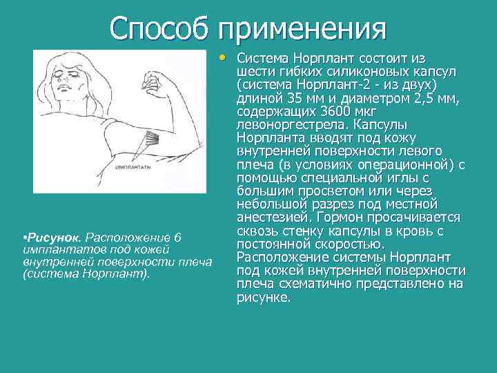 Способ применения • Система Норплант состоит из • Рисунок. Расположение 6 имплантатов под кожей