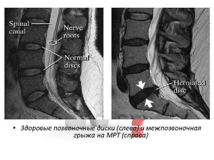 Презентация мрт позвоночника