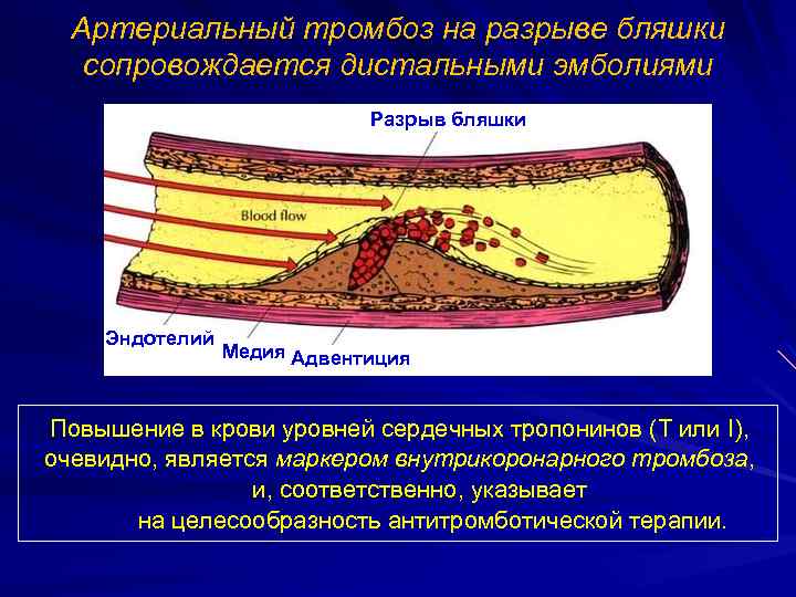 Артериальный тромбоз на разрыве бляшки сопровождается дистальными эмболиями Разрыв бляшки Эндотелий Медия Адвентиция E.