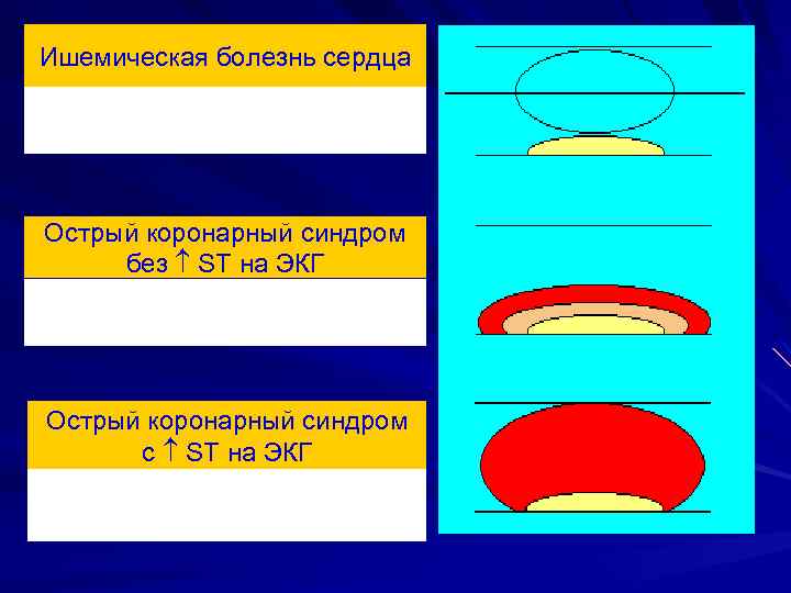 Острый коронарный синдром Ишемическая болезнь сердца без ST на ЭКГ • Стабильная стенокардия Острый