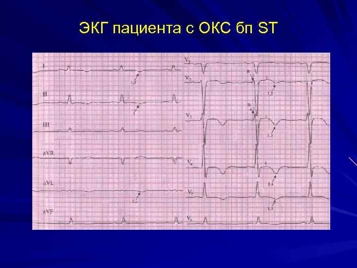 Карта вызова при окс с подъемом st