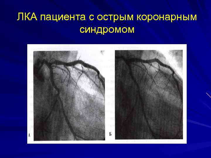 Острый коронарный синдром карта вызова