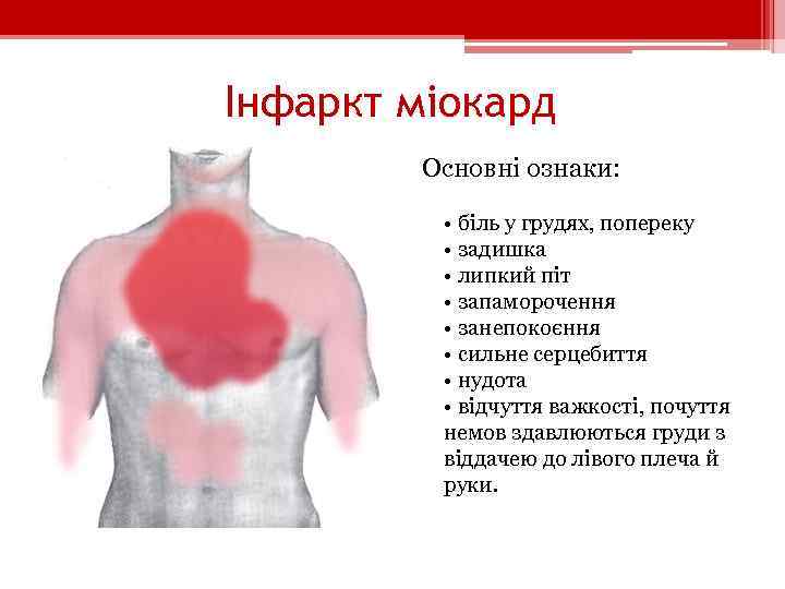 Інфаркт міокард Основні ознаки: • біль у грудях, попереку • задишка • липкий піт