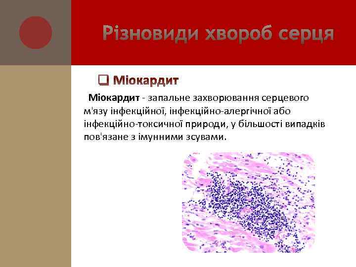 Різновиди хвороб серця q Міокардит - запальне захворювання серцевого м'язу інфекційної, інфекційно-алергічної або інфекційно-токсичної