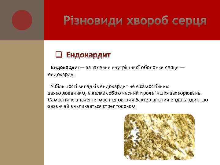 Різновиди хвороб серця q Ендокардит— запалення внутрішньої оболонки серця — ендокарду. У більшості випадків