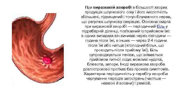 При виразковій хворобі в більшості хворих продукція шлункового соку і його кислотність збільшені, підвищений
