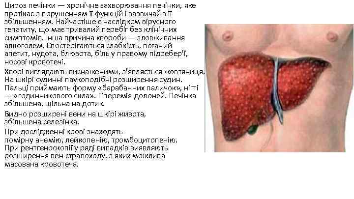 Цироз печінки — хронічне захворювання печінки, яке протікає з порушенням її функцій і зазвичай