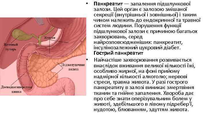  • Панкреатит — запалення підшлункової залози. Цей орган є залозою змішаної секреції (внутрішньої