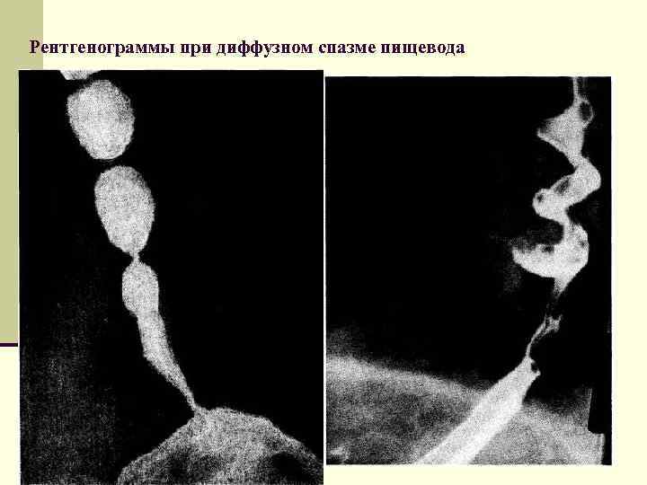 Рентгенограммы при диффузном спазме пищевода 
