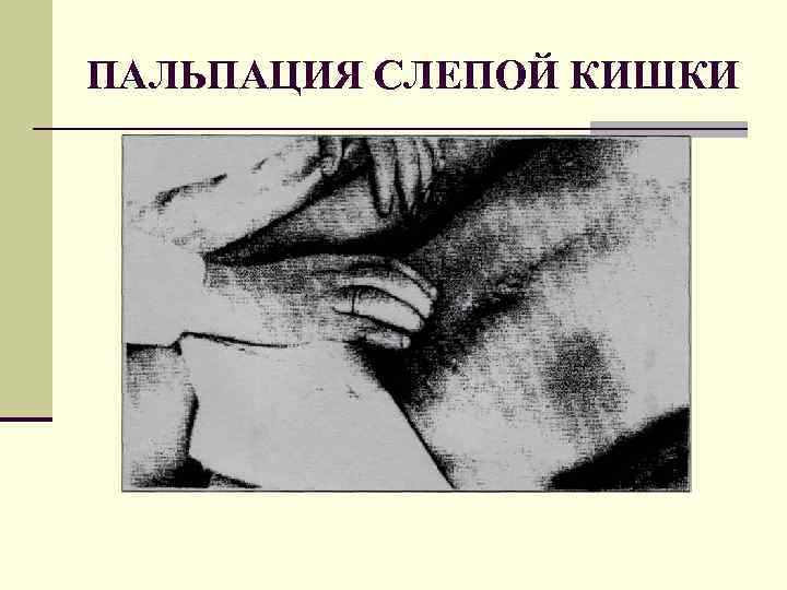 ПАЛЬПАЦИЯ СЛЕПОЙ КИШКИ 