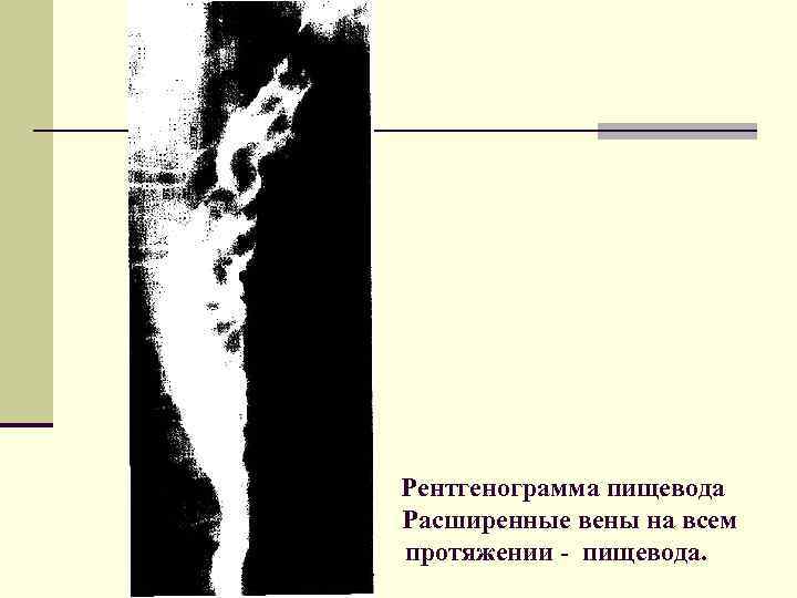 Рентгенограмма пищевода Расширенные вены на всем протяжении - пищевода. 