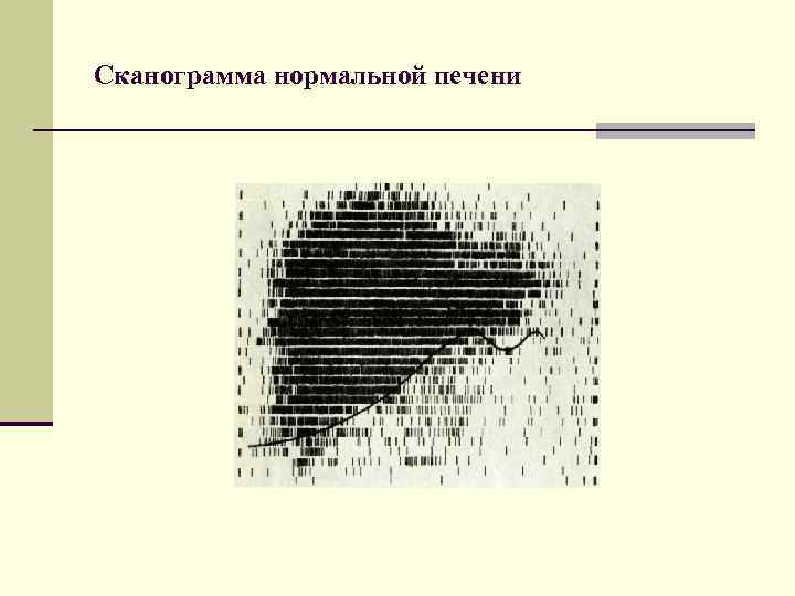 Сканограмма нормальной печени 