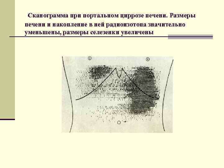Сканограмма при портальном циррозе печени. Размеры печени и накопление в ней радиоизотопа значительно уменьшены,