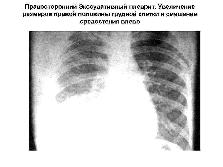 Рентгенологическая картина при экссудативном плеврите