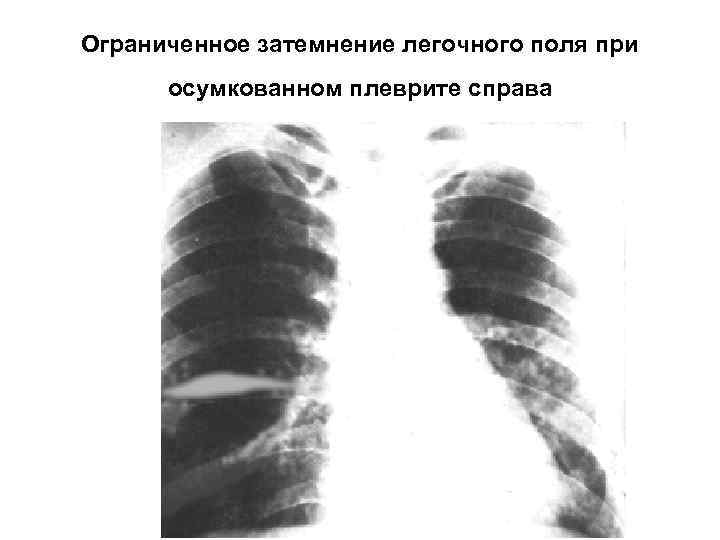 Затемнение верхней доли легкого. Синдром тотального затемнения легочного поля. Синдром ограниченного затемнения легочного поля рентген. Осумкованный плеврит рентген. Ограниченное затемнение легочного поля рентген.