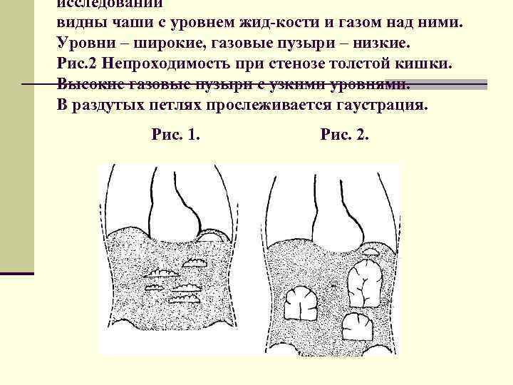 исследовании видны чаши с уровнем жид кости и газом над ними. Уровни – широкие,