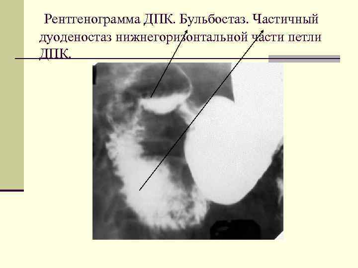 Рентгенограмма ДПК. Бульбостаз. Частичный дуоденостаз нижнегоризонтальной части петли ДПК. 