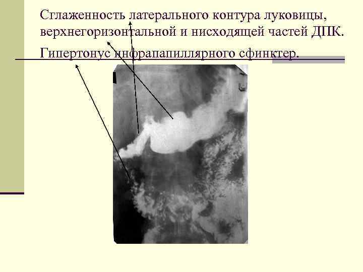 Сглаженность латерального контура луковицы, верхнегоризонтальной и нисходящей частей ДПК. Гипертонус инфрапапиллярного сфинктер. 