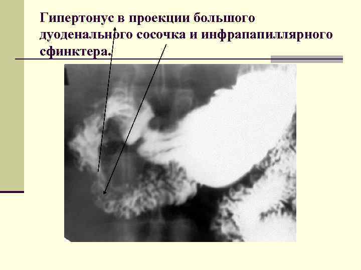 Гипертонус в проекции большого дуоденального сосочка и инфрапапиллярного сфинктера. 