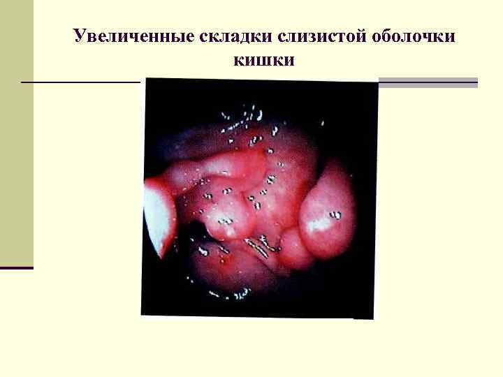 Увеличенные складки слизистой оболочки кишки 