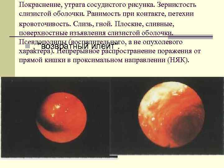 Покраснение, утрата сосудистого рисунка. Зернистость слизистой оболочки. Ранимость при контакте, петехии кровоточивость. Слизь, гной.