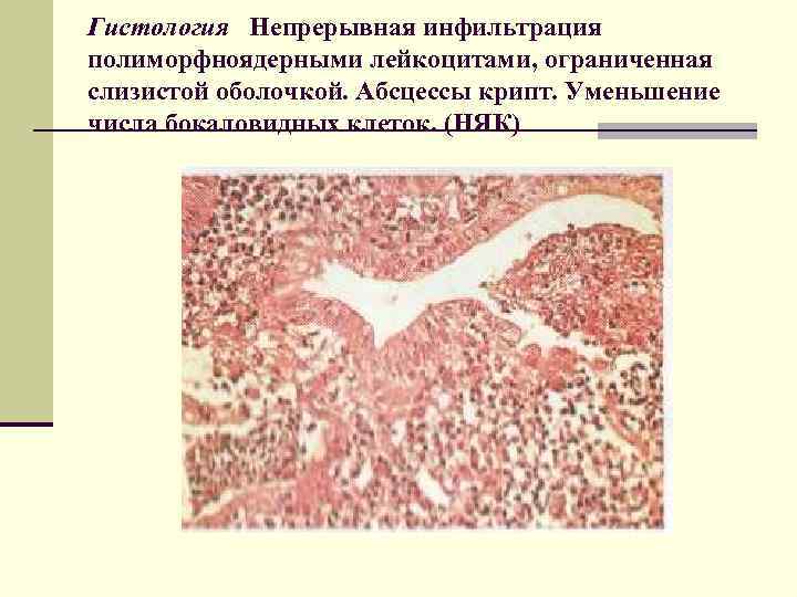 Гистология Непрерывная инфильтрация полиморфноядерными лейкоцитами, ограниченная слизистой оболочкой. Абсцессы крипт. Уменьшение числа бокаловидных клеток.