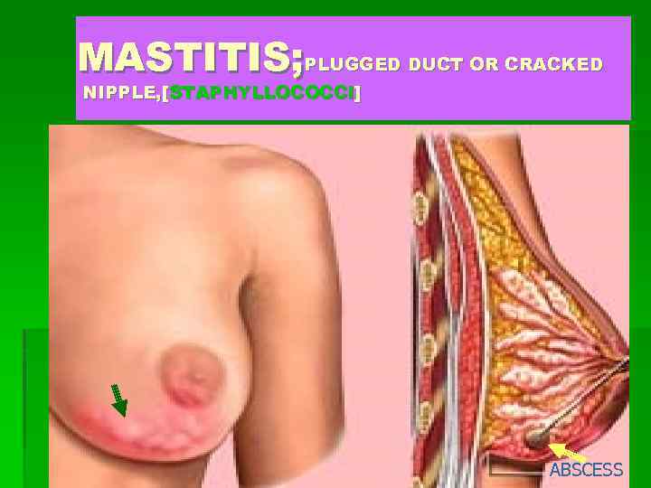 MASTITIS; PLUGGED DUCT OR CRACKED NIPPLE, [STAPHYLLOCOCCI] ABSCESS 