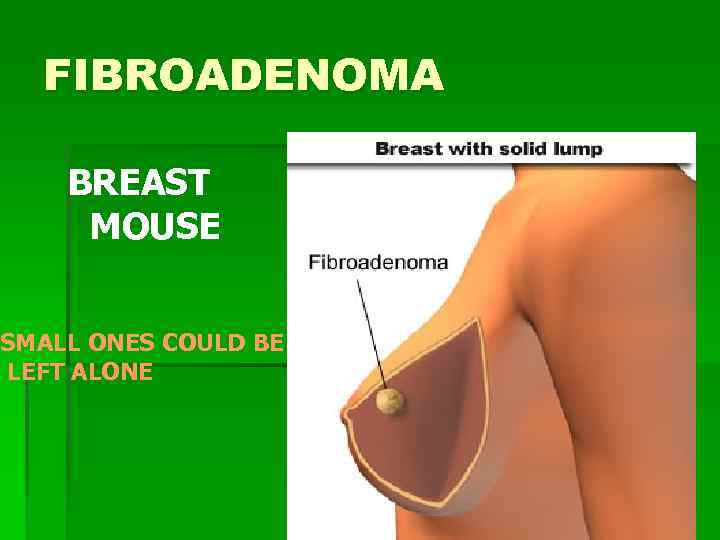 FIBROADENOMA BREAST MOUSE SMALL ONES COULD BE LEFT ALONE 