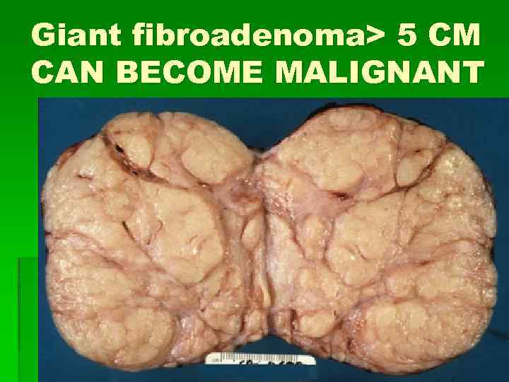 Giant fibroadenoma> 5 CM CAN BECOME MALIGNANT 
