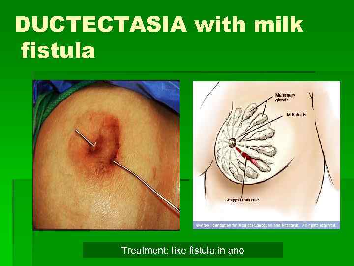 DUCTECTASIA with milk fistula Treatment; like fistula in ano 