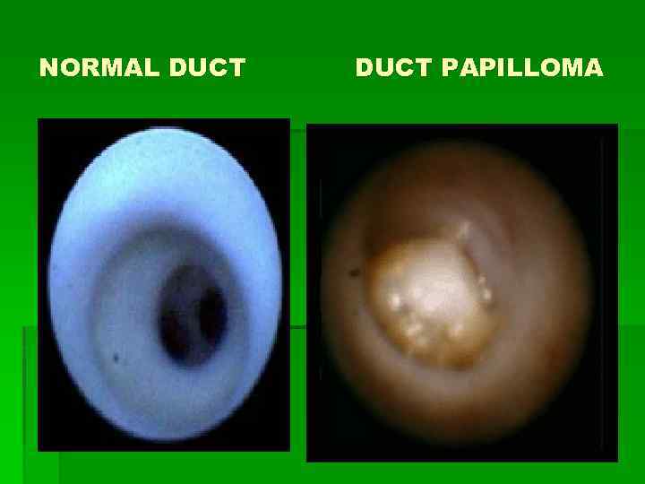 NORMAL DUCT PAPILLOMA 