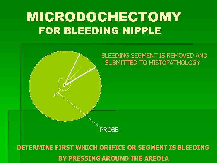 MICRODOCHECTOMY FOR BLEEDING NIPPLE BLEEDING SEGMENT IS REMOVED AND SUBMITTED TO HISTOPATHOLOGY PROBE DETERMINE