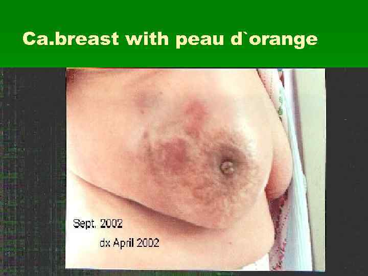 Ca. breast with peau d`orange 