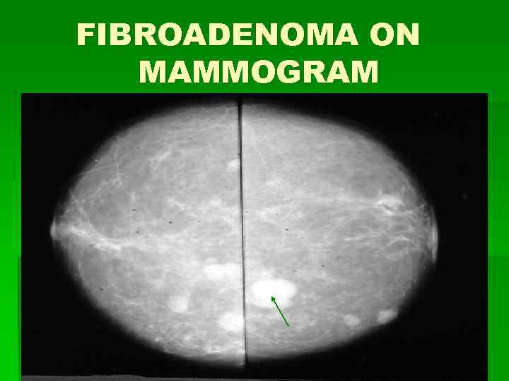 FIBROADENOMA ON MAMMOGRAM 