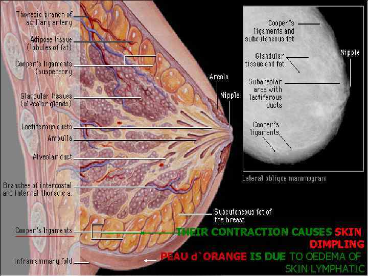 THEIR CONTRACTION CAUSES SKIN DIMPLING PEAU d`ORANGE IS DUE TO OEDEMA OF SKIN LYMPHATIC