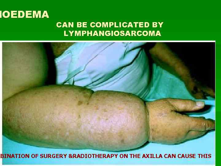 HOEDEMA CAN BE COMPLICATED BY LYMPHANGIOSARCOMA MBINATION OF SURGERY &RADIOTHERAPY ON THE AXILLA CAN