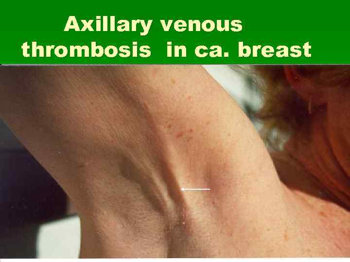 Axillary venous thrombosis in ca. breast 