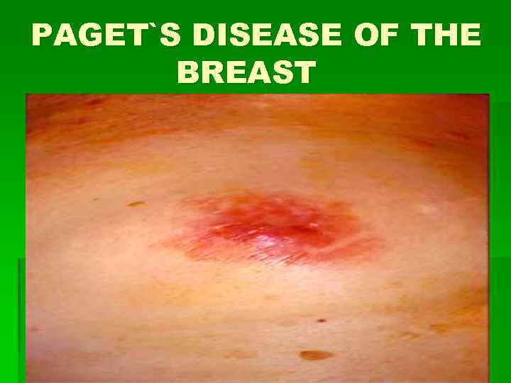 PAGET`S DISEASE OF THE BREAST 