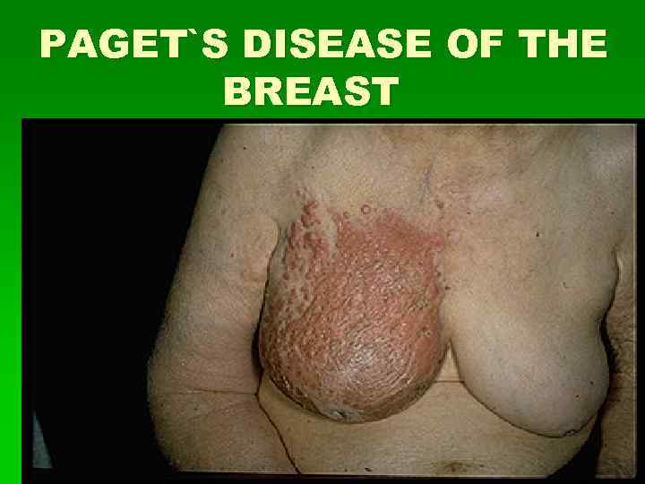 PAGET`S DISEASE OF THE BREAST 
