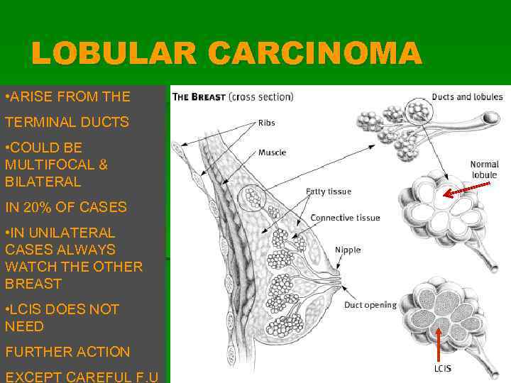 LOBULAR CARCINOMA • ARISE FROM THE TERMINAL DUCTS • COULD BE MULTIFOCAL & BILATERAL