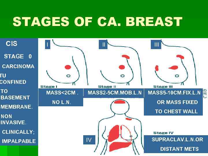 STAGES OF CA. BREAST CIS I I II III STAGE 0 CARCINOMA TU CONFINED
