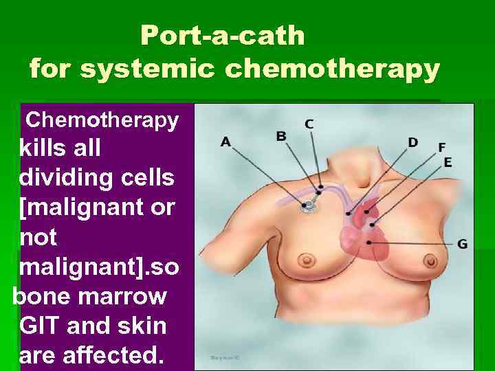 Port-a-cath for systemic chemotherapy Chemotherapy kills all dividing cells [malignant or not malignant]. so