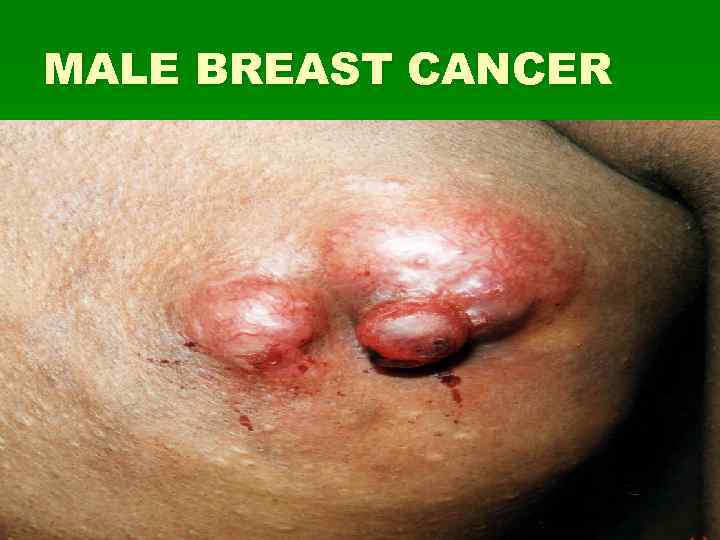MALE BREAST CANCER 