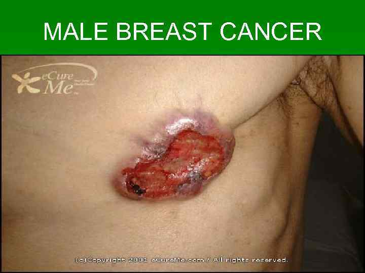 MALE BREAST CANCER 