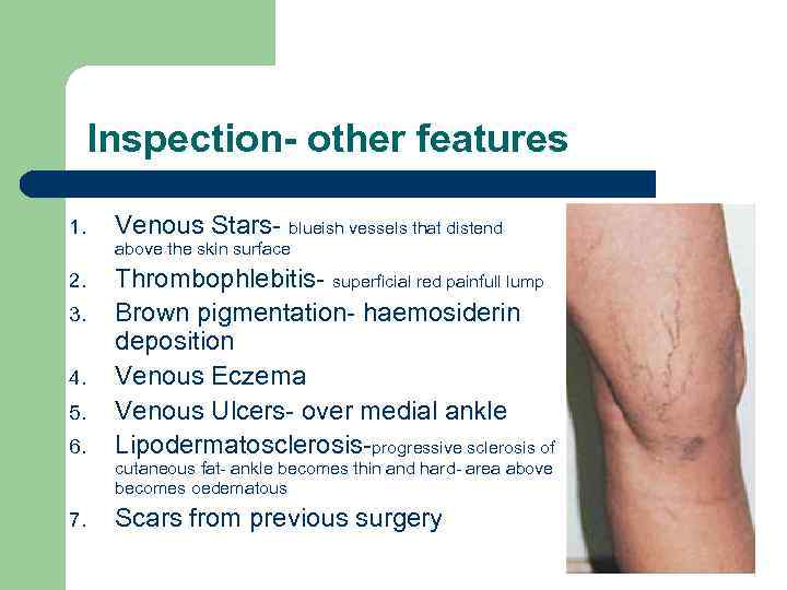 Inspection- other features 1. Venous Stars- blueish vessels that distend above the skin surface