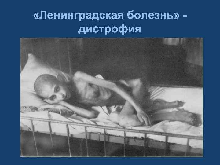  «Ленинградская болезнь» дистрофия 