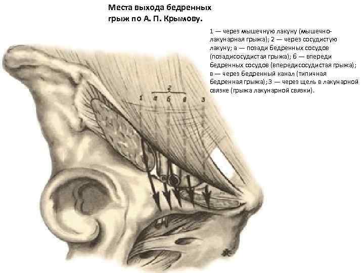 Места выхода бедренных грыж по А. П. Крымову. 1 — через мышечную лакуну (мышечнолакунарная