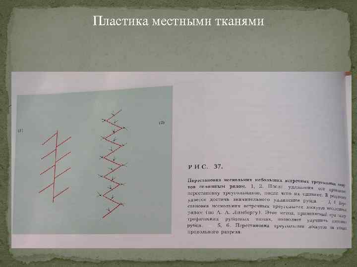 Пластика местными тканями 